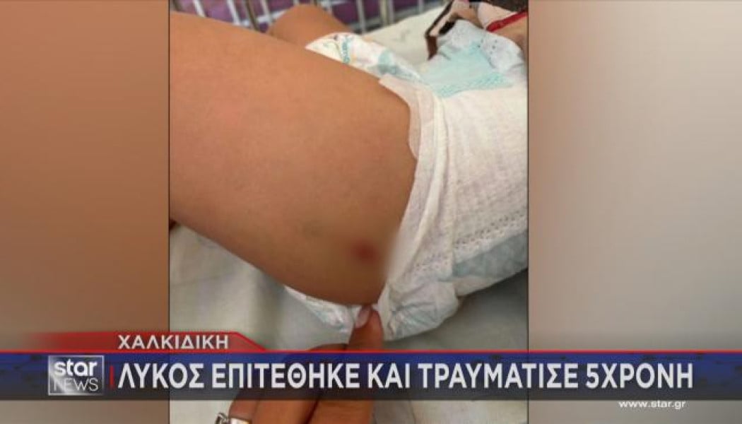 Σοκ στη Χαλκιδική: Λύκος επιτέθηκε σε 5χρονο κορίτσι (ΒΙΝΤΕΟ)